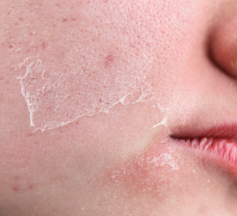 Hormones May Be Behind Your Jawline Breakouts.