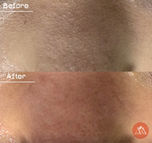 How to Refine Oily Skin Pores Without Aggressive Extraction