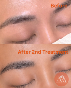 Faded PMU Brows: Is Laser Removal the Only Option?