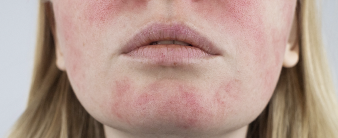 Facial Redness? Stop Buying More Skincare Products.