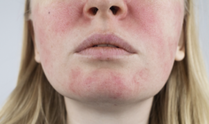 Facial Redness? Stop Buying More Skincare Products.