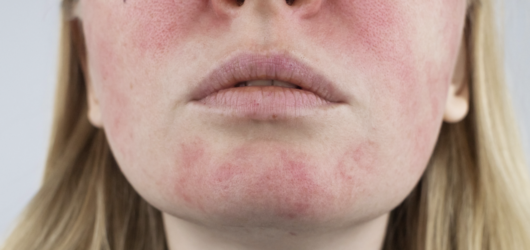 Facial redness caused by a weakened skin barrier
