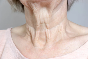 Signs of neck aging and sun damage