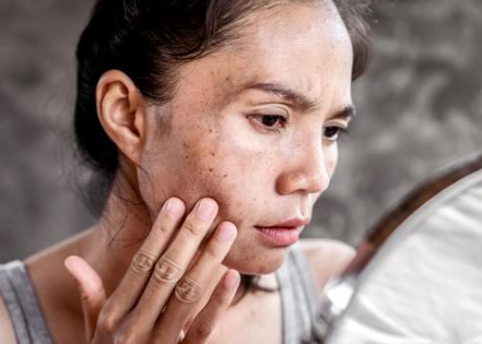 The Brown Spots on Your Face Are Not All the Same