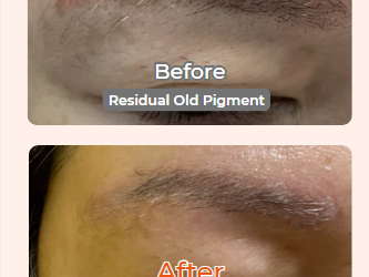 Why Should You Lighten Old Eyebrow Tattoo Pigment Before New Eyebrow Tattoo? Before and after comparison of eyebrow tattoo lightening showing existing PMU pigment before treatment and immediately after the first PMU Lightening session at AURA Korea Wellness Clinic in Burnaby, BC.